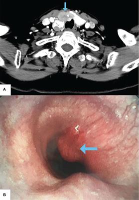 Case report: Thyroid carcinoma invading trachea: Multidisciplinary resection and reconstruction assisted by extracorporeal membrane oxygenation